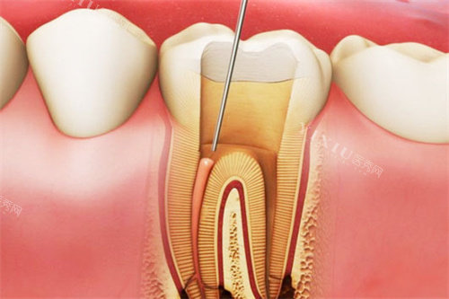 根管治疗牙神经图