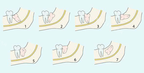 阻生智齿的不同类型