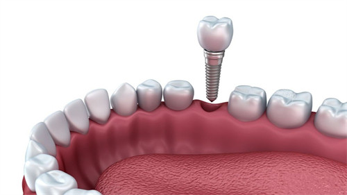 济南种植牙价格表2024快来看，国产2980+韩国登腾3500+美国皓圣5000+瑞士12000+(图1)