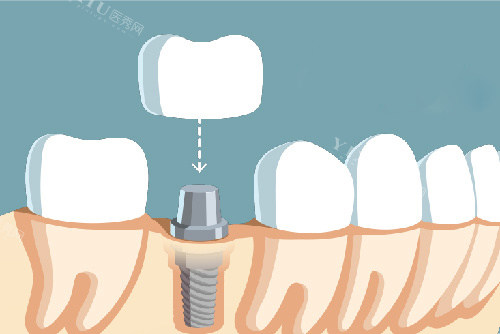 单颗种植牙牙冠安装漫画图