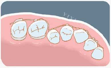 牙齿矫正漫画牙齿图