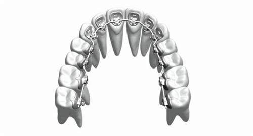 牙齿矫正舌侧矫正牙套概念透视图