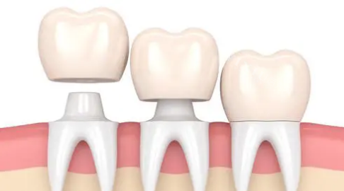 人工牙冠示意图
