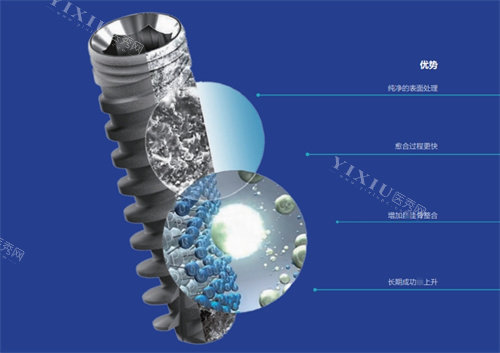 以色列雅定种植体怎么样？种牙优势特点有哪些收费多少钱一颗？(图4)