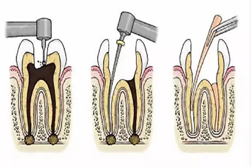 根管治疗步骤