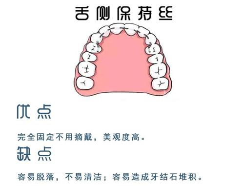 牙齿矫正舌侧保持器优缺点图