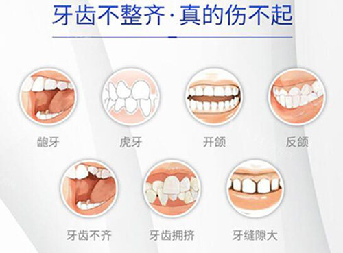 牙齿不整齐都有哪些类型