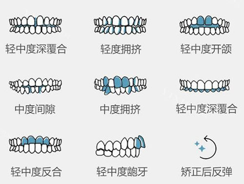 哪些牙齿需要做正畸改善