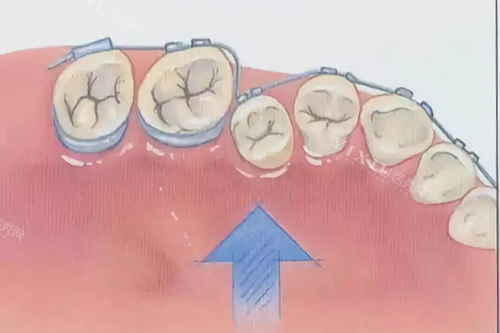 牙齿矫正示意图