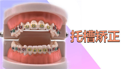 欧欧球面自锁托槽价格多少钱？作为国产高性价比牙套价格大概13000元起(图4)