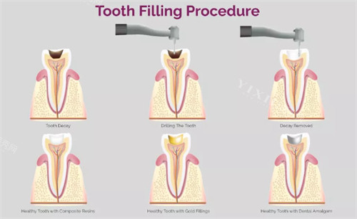 补牙过程图
