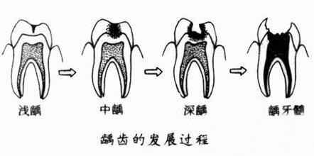 龋齿的发展过程示意图