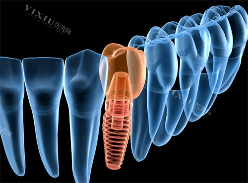 韩国易普莱种植牙怎么样价格多少？优势特点／适应症／口碑评价一览~(图3)