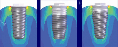 韩国易普莱种植牙怎么样价格多少？优势特点／适应症／口碑评价一览~(图5)
