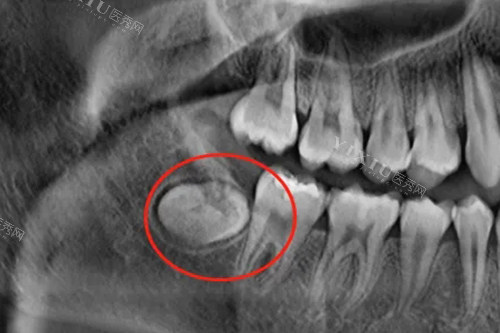 阻生智齿埋伏牙片示意图