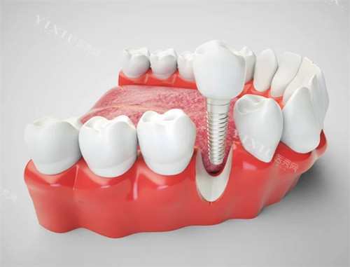 韩国易普莱种植牙怎么样价格多少？优势特点／适应症／口碑评价一览~(图1)