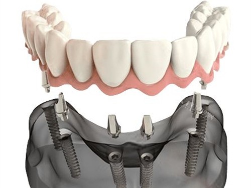 半口种植牙联排牙冠安装示意图