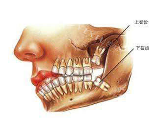 上下智齿位置示意图