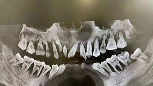 牙槽骨缺失照片图