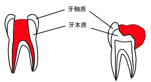 牙齿内息肉外溢