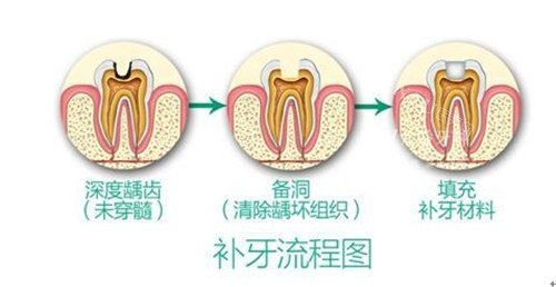 补牙过程图