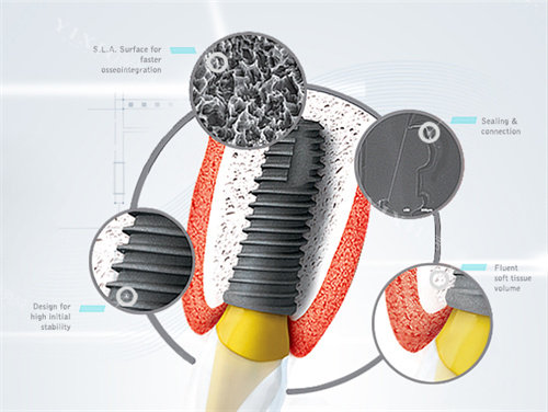 登特斯种植牙细节放大
