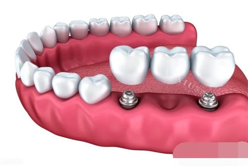 两颗种植牙安装联排牙冠漫画示意图