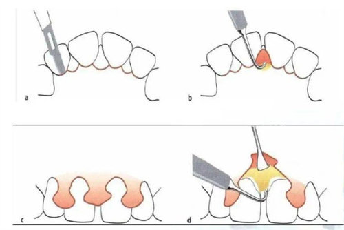 牙周炎翻瓣手术怎么做