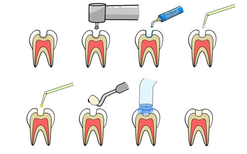 补牙步骤