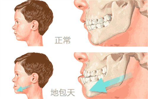 地包天与正常咬合对比动画图