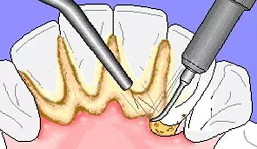 牙结石超声波洁牙示意图