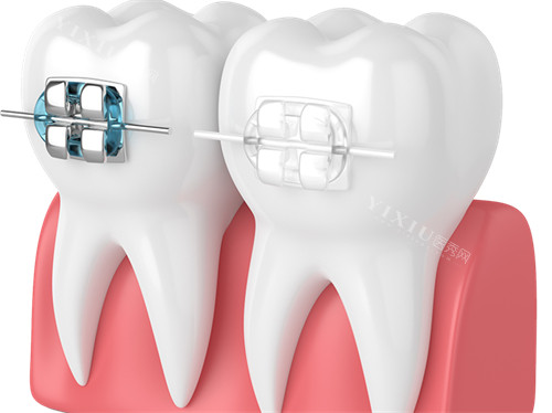 牙齿矫正金属托槽及陶瓷托槽漫画图