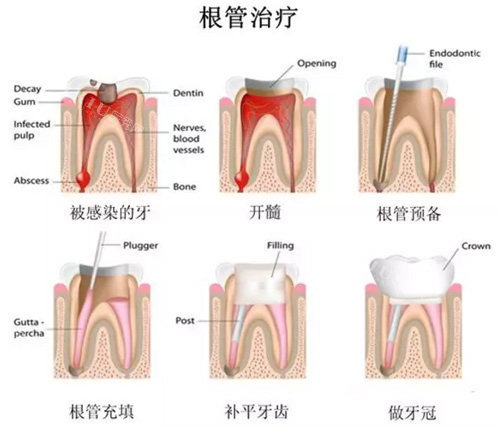 牙齿根管治疗过程图