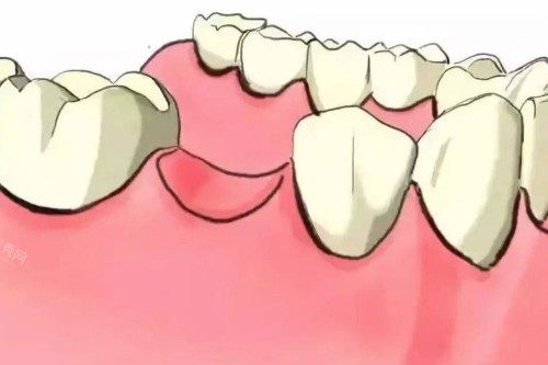 牙齿缺失模型图