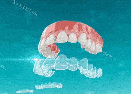 中山牙齿矫正一般多少钱？金属7000元+／半隐形15800+／隐形26800元+！(图2)