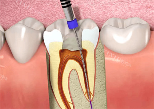 牙齿根管治填充