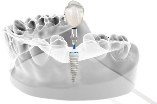 以色列科特斯和韩国奥齿泰哪个好？都靠谱！但各有优缺点，看本文了解科特斯、奥齿泰材质、设计、价格(图2)