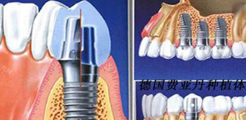 卡瓦种植牙怎么样？是哪里生产的价格收费一般是多少？