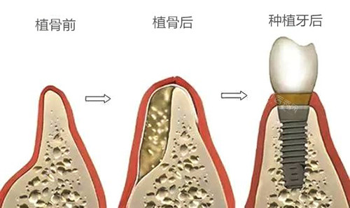 种植牙植骨前后于种植牙后漫画图