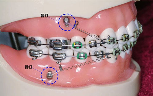牙齿矫正骨钉种植钉牙齿模型