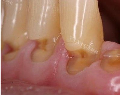 牙龈萎缩能种牙吗？做种植牙有年龄限制吗速来了解！(图3)