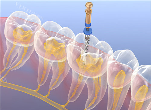 根管治疗透视图