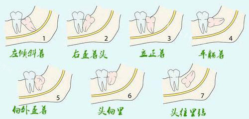 不同类型的智齿示意图