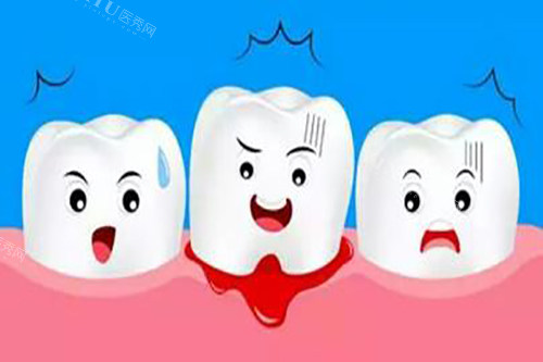 牙龈萎缩能种牙吗？做种植牙有年龄限制吗速来了解！(图2)