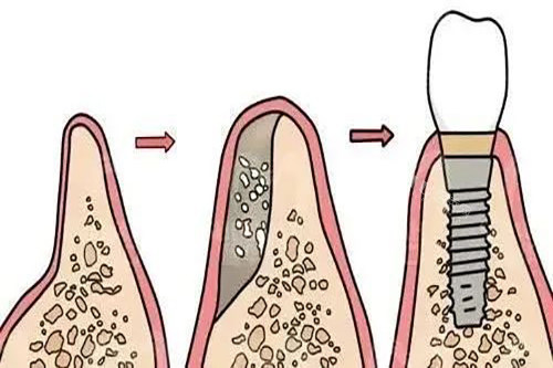 先植骨再种牙过程示意图