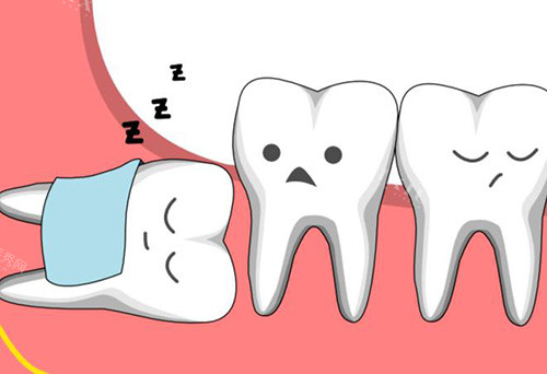 阻生智齿示意图
