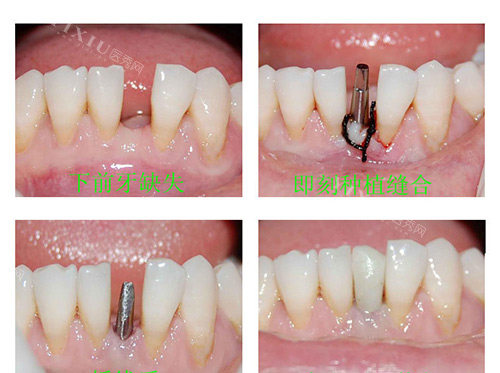 韩国伊诺种植牙能用多久？一般使用寿命在20年左右，维护得当可以一直用！(图4)