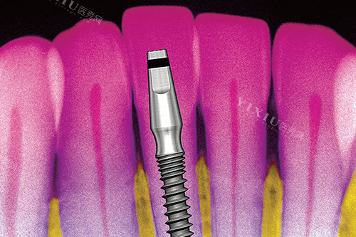 韩国伊诺种植牙能用多久？一般使用寿命在20年左右，维护得当可以一直用！(图2)