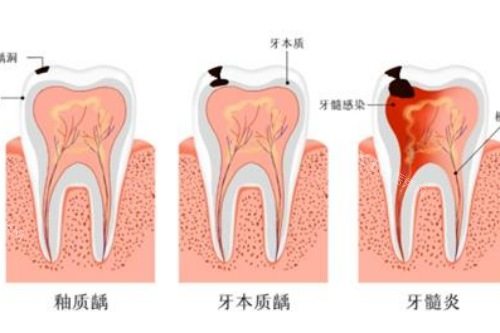 牙髓炎和其他牙齿炎症的对比