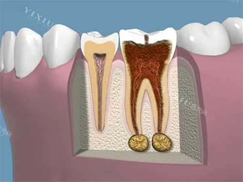 牙齿龋坏根管治疗前